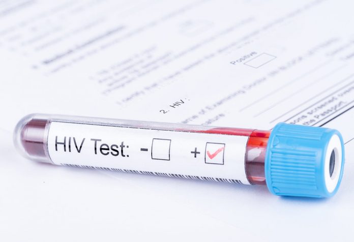 كيف يتم اختبار فيروس نقص المناعة البشرية؟