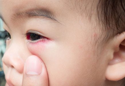 أنواع الالتهابات الشائعة في العين عند الأطفال