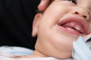 الأسنان الملتوية عند الرضع - الأسباب وكيفية التعامل معها