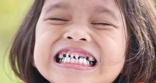 كيفية التعامل مع الأسنان المكسورة أو المشروخة عند الطفل؟