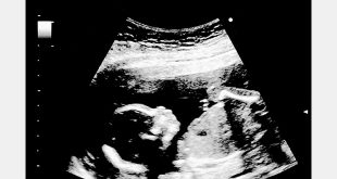 الموجات فوق الصوتية الحوامل في الأسبوع الثامن عشر: الإجراء، وجود تشوهات، وغير ذلك الكثير