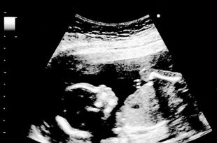 الموجات فوق الصوتية الحوامل في الأسبوع الثامن عشر: الإجراء، وجود تشوهات، وغير ذلك الكثير