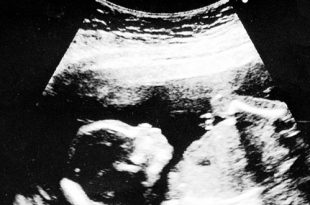 الموجات فوق الصوتية الحوامل في الأسبوع السابع عشر: الإجراء، وجود تشوهات، وغير ذلك الكثير
