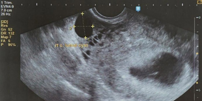 الفحص بالموجات فوق الصوتية في الأسبوع 5 من الحمل: الإجراءات، والتشوهات وغيرها الكثير