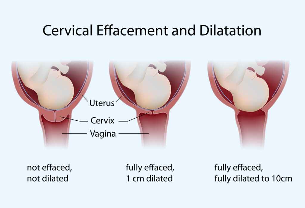 مرحلة تمدد أو توسع عنق الرحم (Dilation)