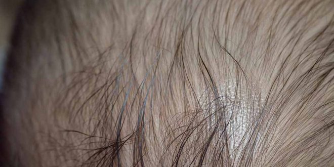 مرض الثعلبة (Alopecia Areata) عند الأطفال