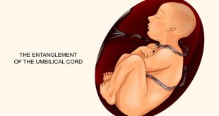 الحبل السري حول رقبة الجنين: الأسباب والعلامات والعلاجات