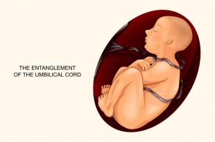 الحبل السري حول رقبة الجنين: الأسباب والعلامات والعلاجات