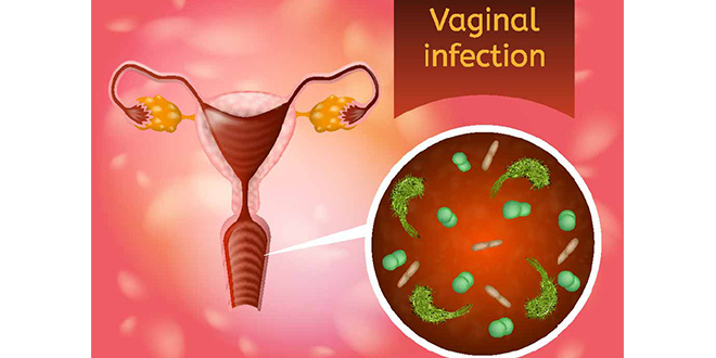 قائمة بأكثر 7 أنواع من التهابات المهبل شيوع ا أثناء الحمل