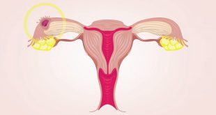الحمل خارج الرحم - الأسباب والأعراض والعلاج