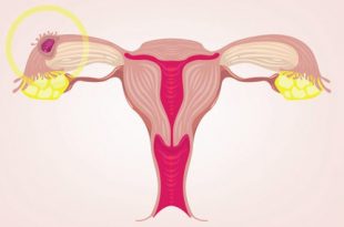 الحمل خارج الرحم - الأسباب والأعراض والعلاج