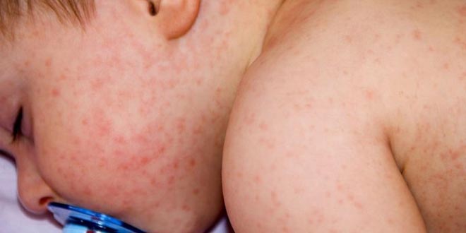 فضة أديليد مقدس  حساسية جلد الطفل: الأسباب والعلامات والعلاج