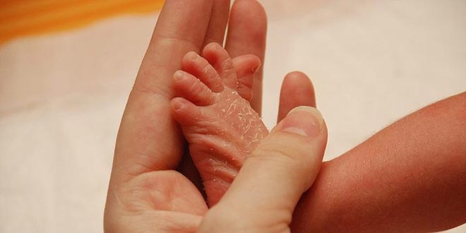 البشرة الجافة عند الأطفال الرضع