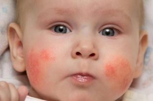 الطفح الجلدي على وجه الطفل الرضيع - الأنواع والأسباب والعلاج