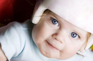 الرأس الوارِب عند الأطفال (متلازمة الرأس المسطح) - الأسباب والعلاج