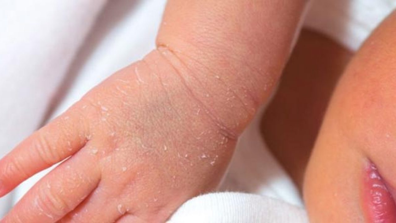 تقشير الجلد عند الأطفال حديثي الولادة الأسباب والعلاج وطرق الوقاية