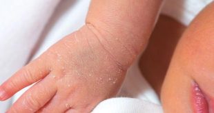 تقشير الجلد عند الأطفال حديثي الولادة – لماذا يحدث؟