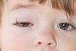 التهاب الملتحمة (العين الوردية) عند الأطفال والرضع
