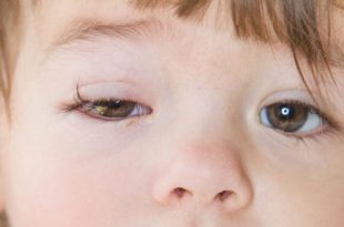 التهاب الملتحمة (العين الوردية) عند الأطفال والرضع