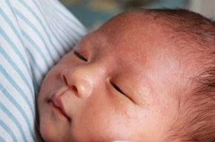 الحساسية ضد الحليب عند الرضع