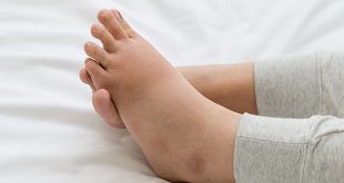 آلام القدم أثناء الحمل