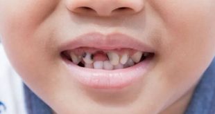 تسوس الأسنان عند الأطفال: الأسباب والأعراض والعلاج