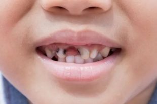 تسوس الأسنان عند الأطفال: الأسباب والأعراض والعلاج