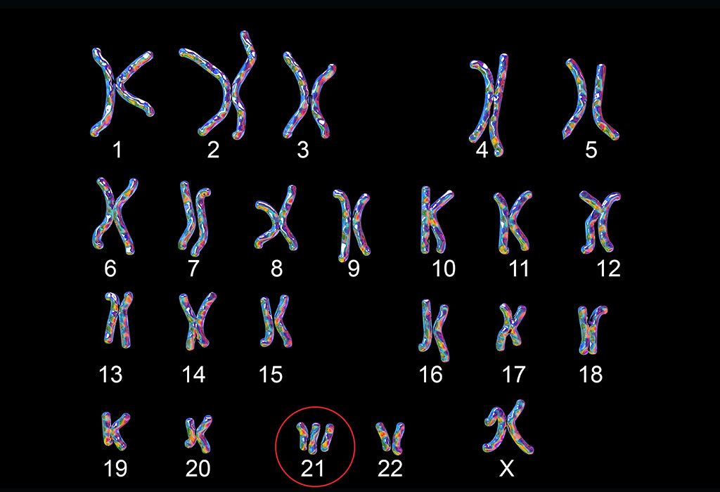 تثلث الصبغي ٢١ – متلازمة داون 