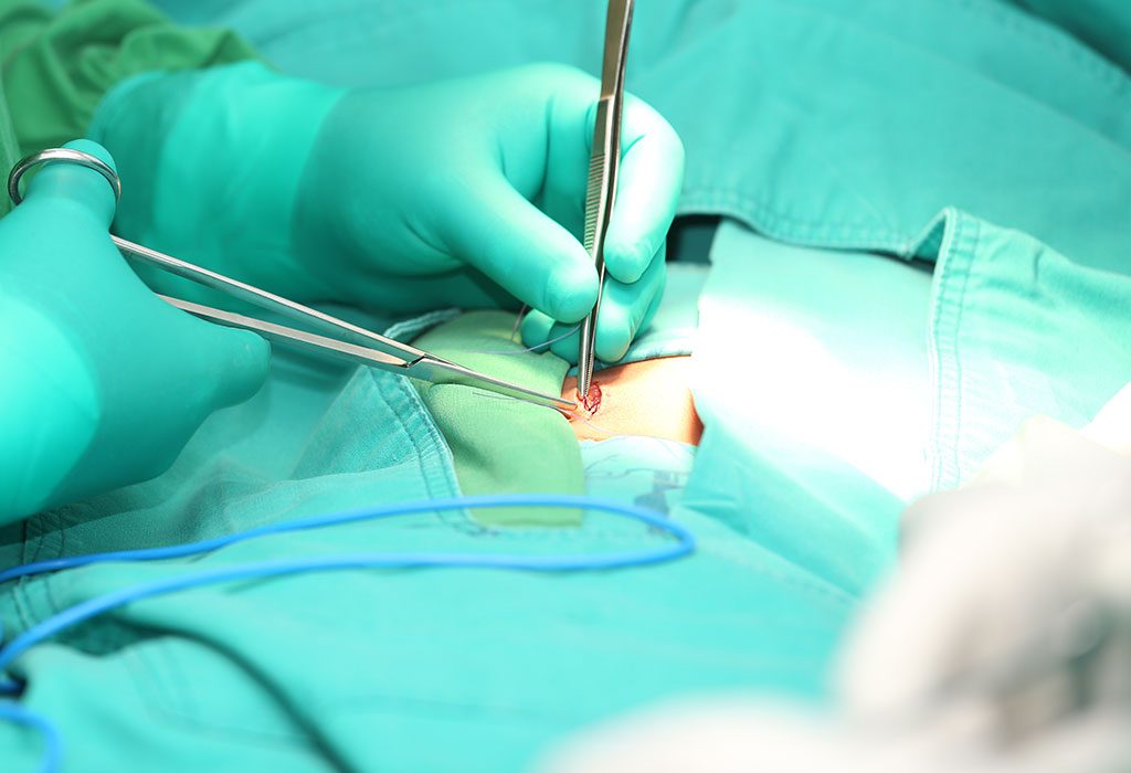 علاج فتق الحمل