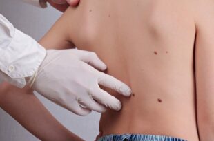 الشامات عند الأطفال